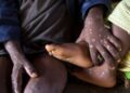 Épidémie : le Monkeypox atteint déjà plus de 19 personnes en République du Congo